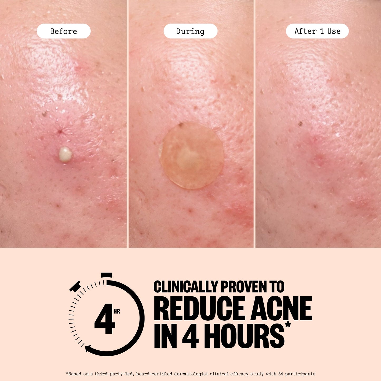 Acne Treatment Dots