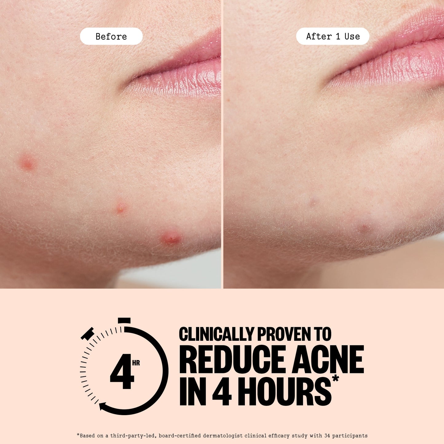 Acne Treatment Dots